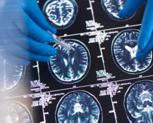 Optimists Share Similar Brain Patterns When Thinking about the Future